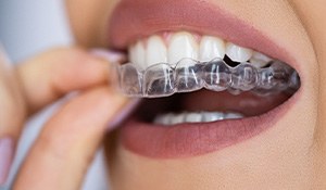 Placing clear aligner on upper teeth