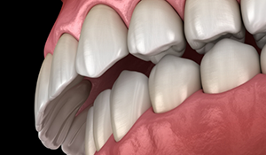 Illustrated mouth with an overbite