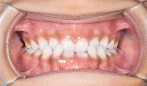 Mouth with a crossbite