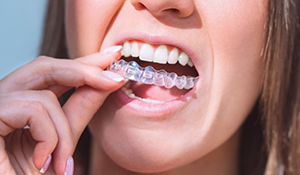 Woman placing a clear aligner over her teeth