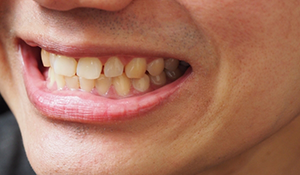 Mouth with slight gaps between the teeth