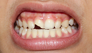 Close up of a mouth with a chipped front tooth