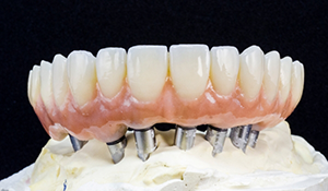 Model of a full denture on dental implants
