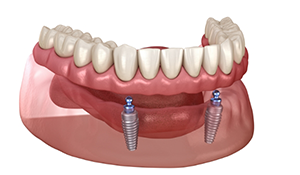 Illustration of a full denture supported by two implants