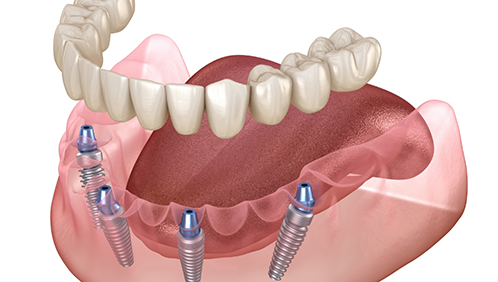 Illustration of a full denture supported by four implants