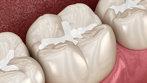 Illustrated tooth with a dental sealant