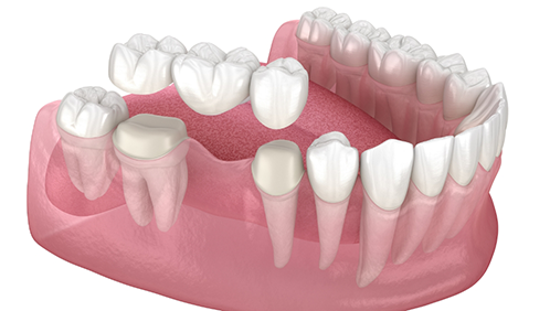 Illustrated dental bridge replacing a missing tooth