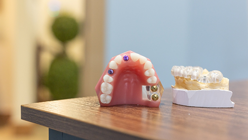 Model of the mouth with dental implants replacing several teeth