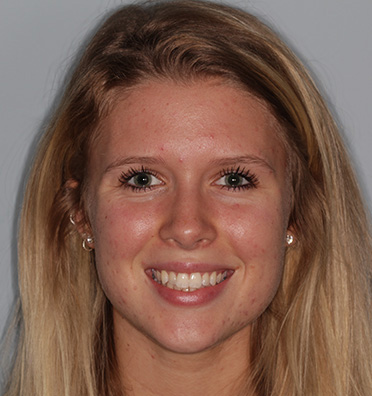 Woman smiling with flawless teeth