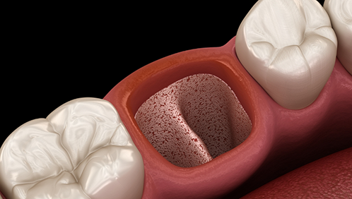 Illustration of an empty socket in the gums after a tooth extraction