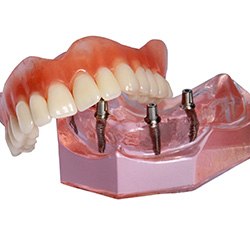 Implant dentures with translucent pink base