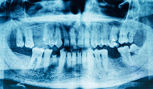 Dental x ray of someone missing several teeth