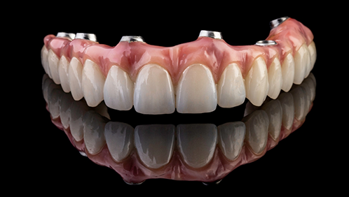 Implant denture
