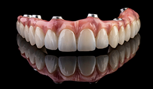 Implant denture