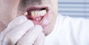 Close up of man missing a lower tooth